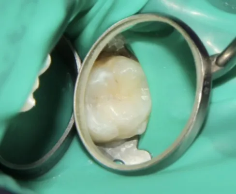 After Aesthetic Composite Fillings