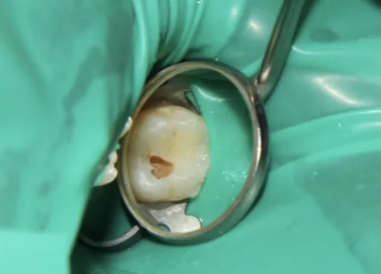 Before Aesthetic Composite Fillings