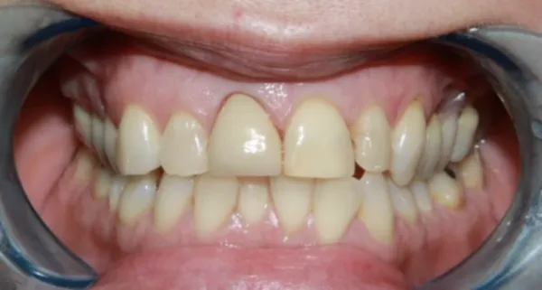 After Dental Crown Restoration