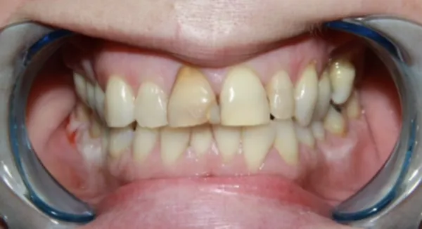 Before Dental Crown Restoration