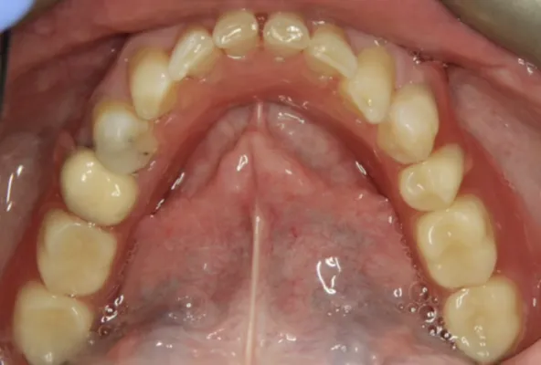 After Flexible Dentures