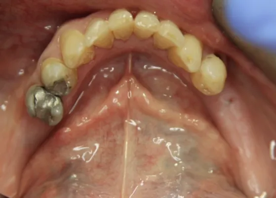 Before Flexible Dentures