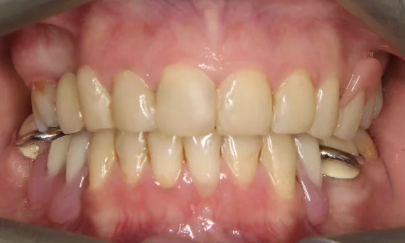 After Full Mouth Rehabilitation