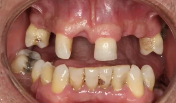 Before Full Mouth Rehabilitation