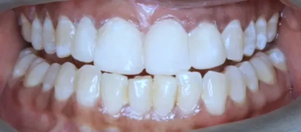 After Smile Design with composite fillings
