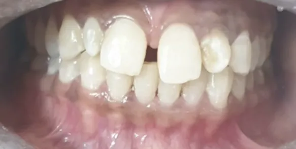Before Smile Design with composite fillings