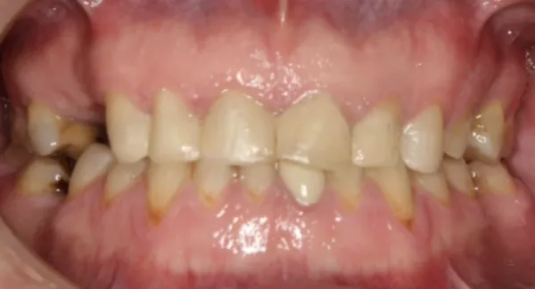 After Severe Tooth Wear Restoration