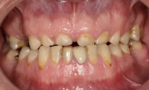 Before Severe Tooth Wear Restoration